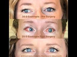 Strabismus Surgery
